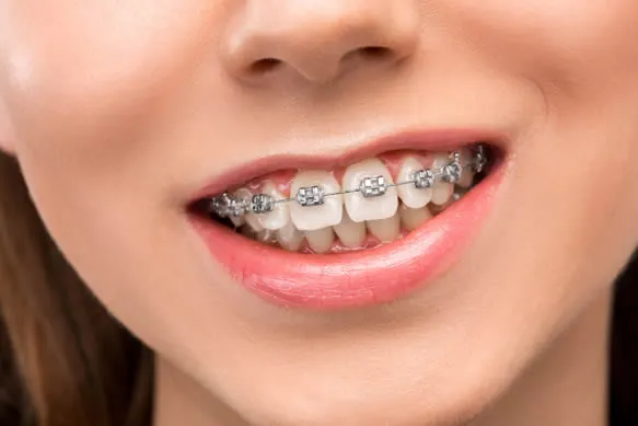 Understanding Malocclusion: Common Bite Problems and Their Solutions