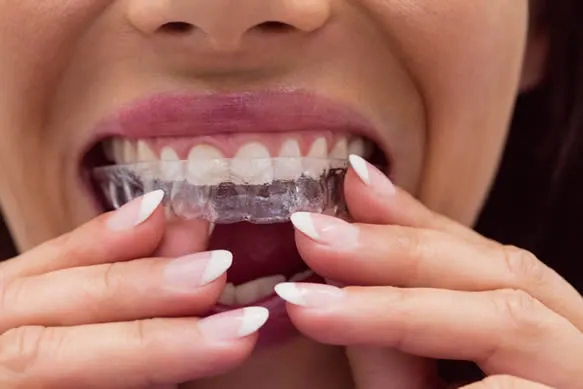 Invisalign St. Louis: Clear Aligner Therapy for Discreet Orthodontic Correction